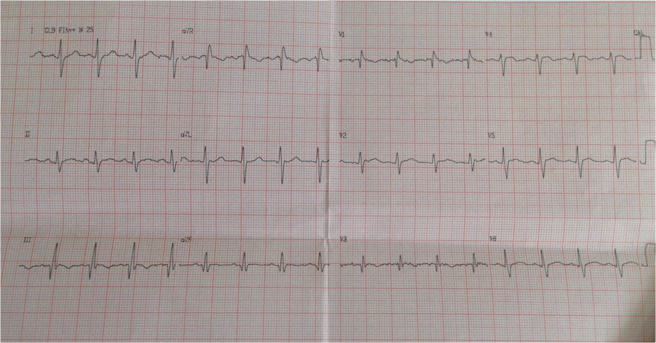 Paciente de 31 años, obeso, con TVP que desarrolla cuadro de TEP