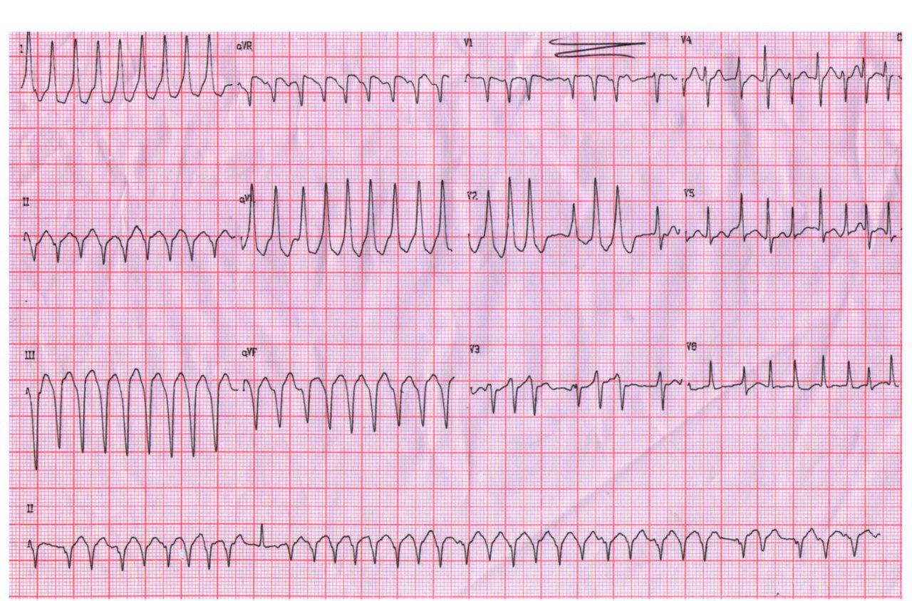 Paciente de 21 años con FA preexcitada por vía posterolateral izquierda
