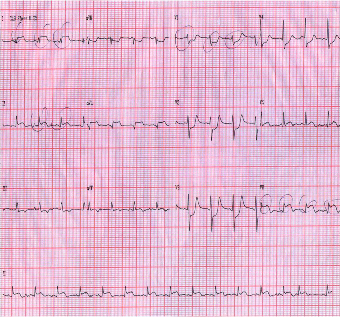 SCA por lesión símil TCI