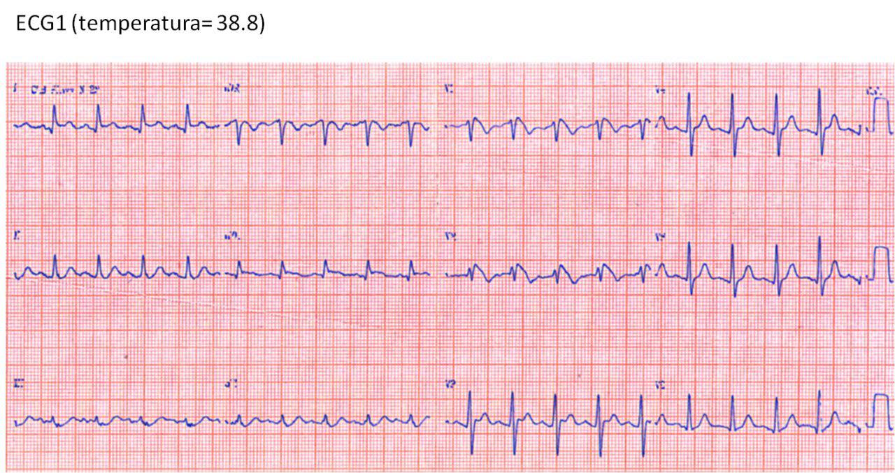 Masculino 52 años. Fiebre post biopsia de próstata