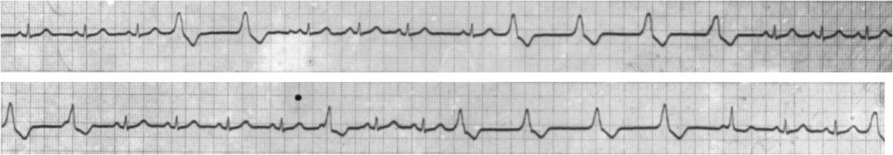 Masculino de 60 años con palpitaciones debidas a parasistolia ventricular