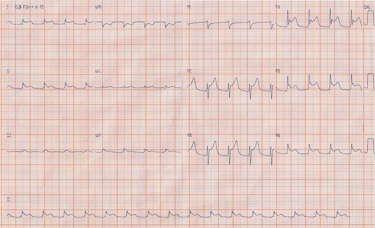 Paciente de 77 años con pericarditis febril por perforación debida a cuerpo extraño intraesofágico