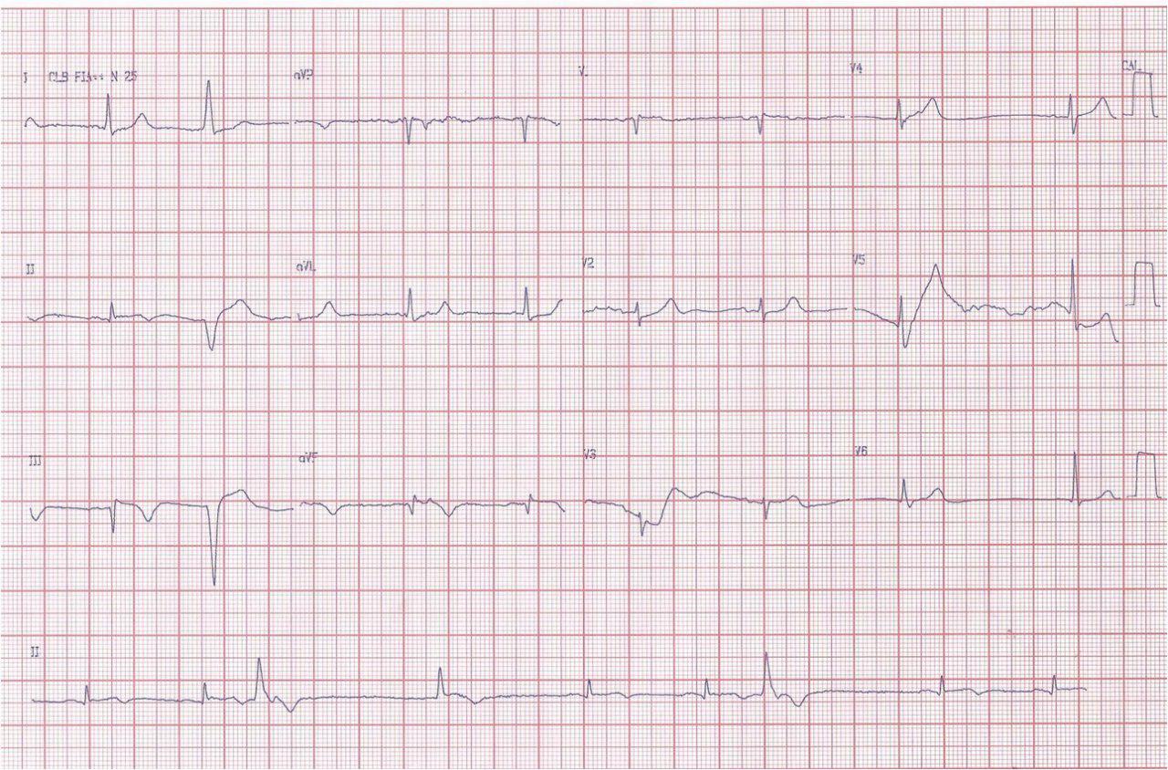 Paciente de 79 años con SCACEST por obstrucción de CD que se angioplastia con RIVA post stent