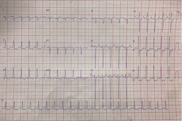 Paciente de 69 años con angor prolongado por suboclusión de TCI y obstrucción total de CD