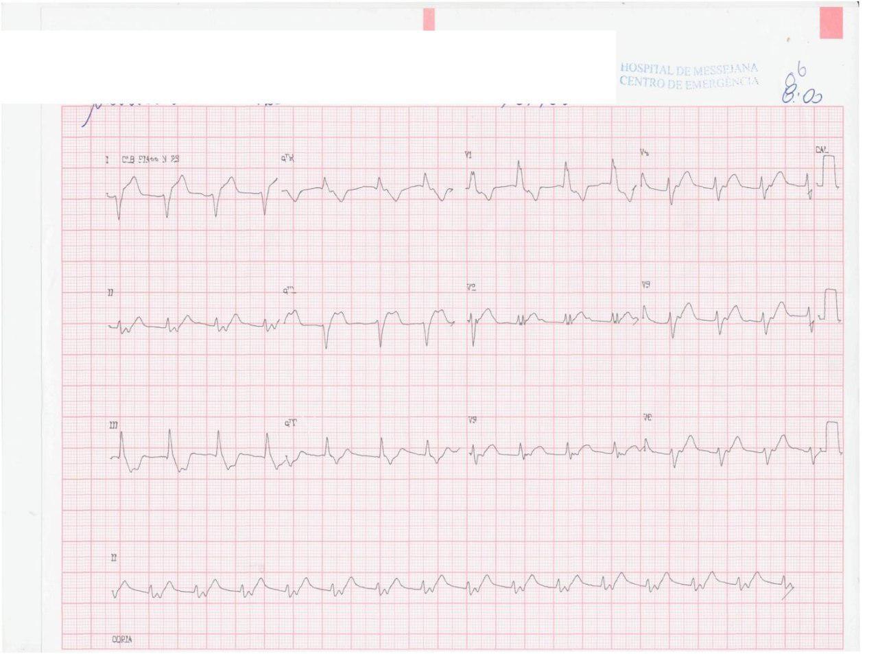 Paciente femenina de 61 años con FR y angor prolongado, con obstrucción de 1º diagonal
