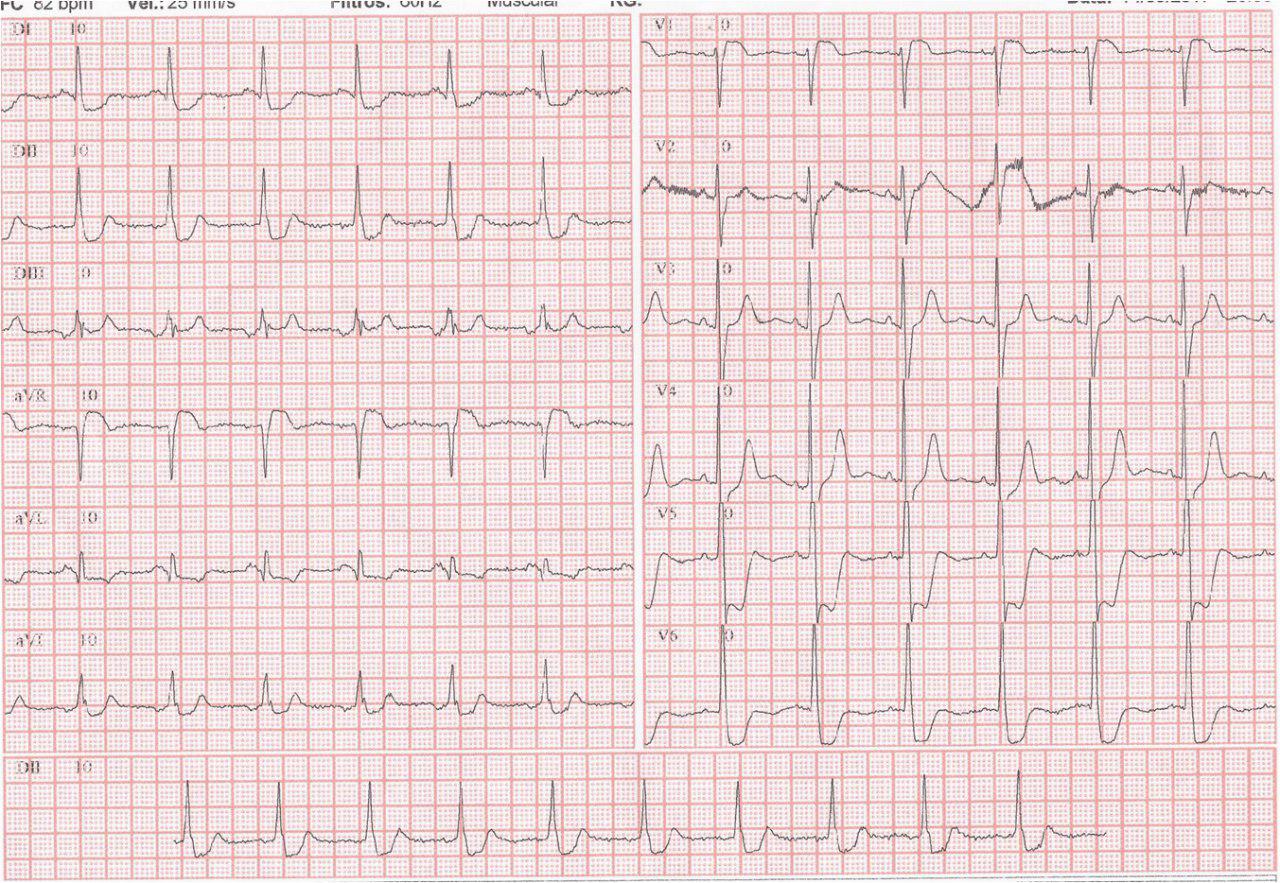 Paciente de 59 años con angor prolongado. Enfermedad de 3 vasos, simil tronco