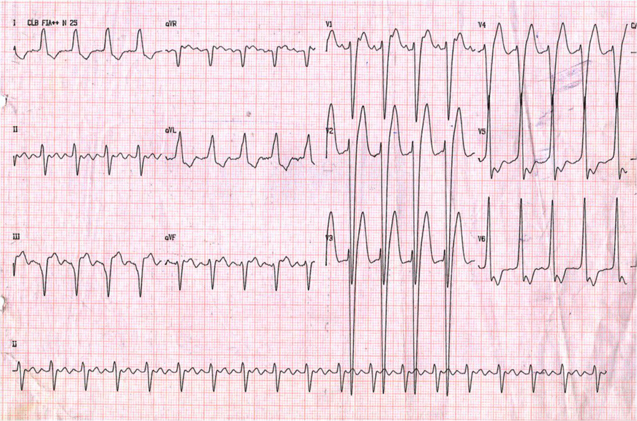 Masculino de 71 años, HTA. Aleteo auricular con imagen de BRI en fase 3