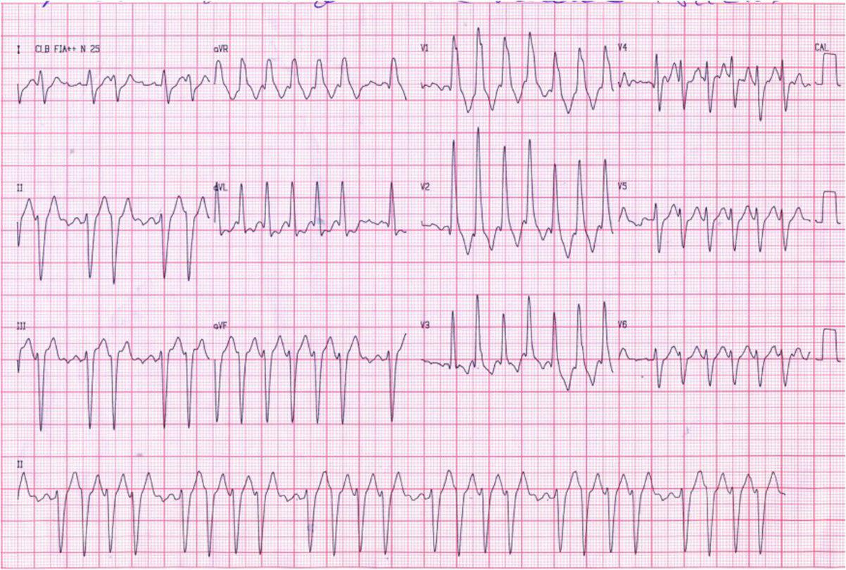 Mujer de 86 años con antecedentes de demencia y ACV. Síndrome de Bayes