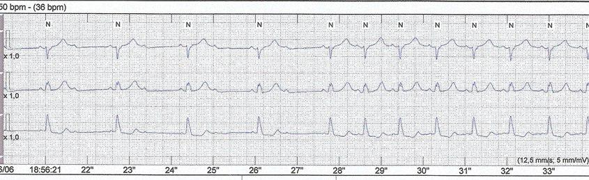 Paciente de 71 años con síncope por BAV de grados variables que llevan al BAVC