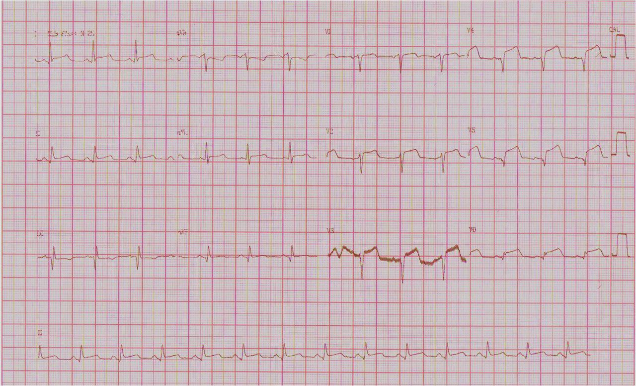 Paciente de 71 años con angor prolongado por oclusión trombótica de DA. Complicación con CIV