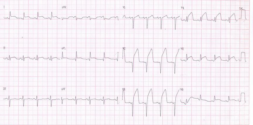 Paciente de 67 años con angor prolongado y déficit neurológico derecho