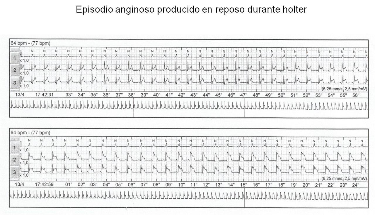Episodio anginoso de reposo durante la realización de un Holter