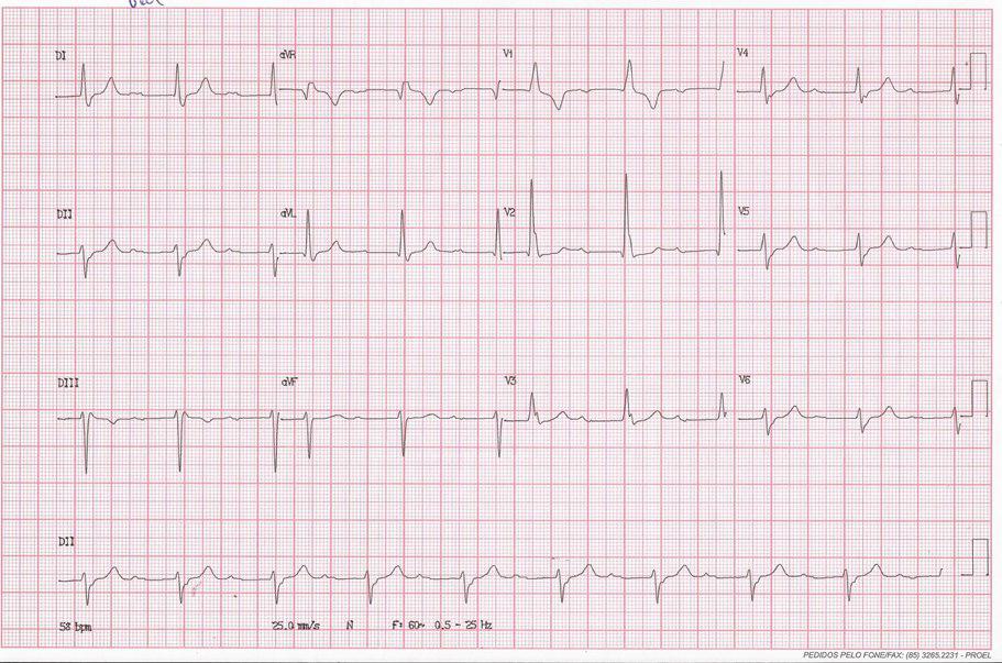 Episodio sincopal en hombre de 76 años por bloqueo tetrafascicular
