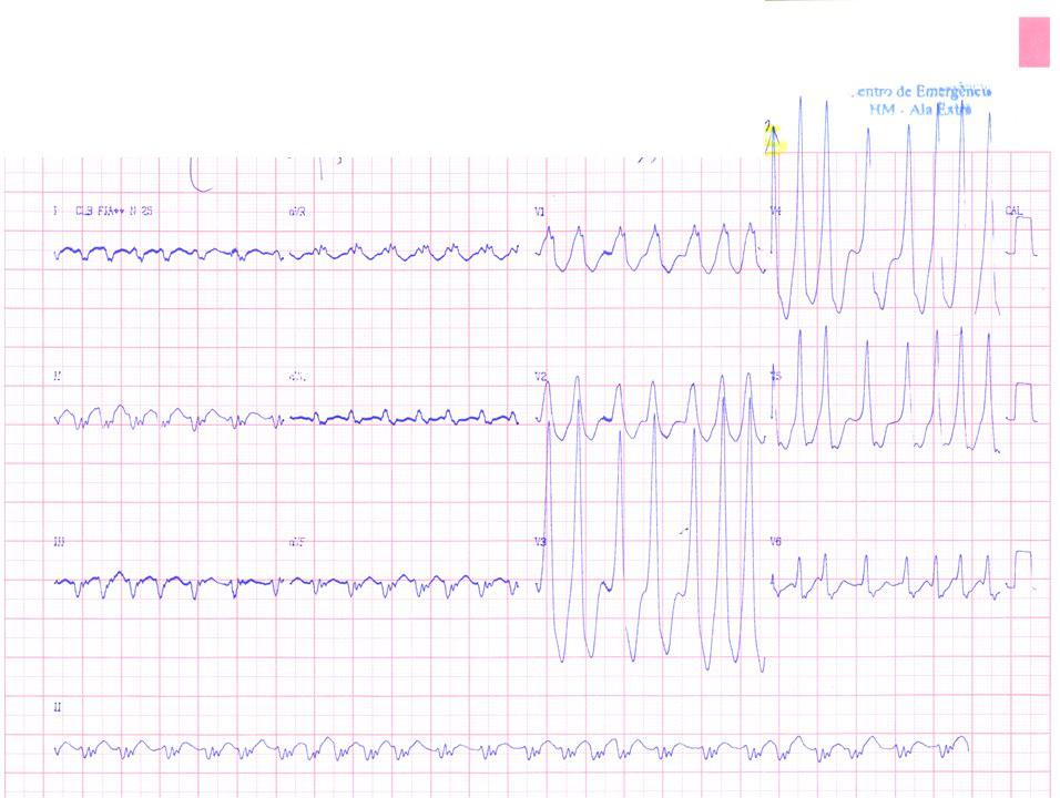 Episodio sincopal en paciente de 90 años que presenta FA pre-excitada por vía lateral izquierda