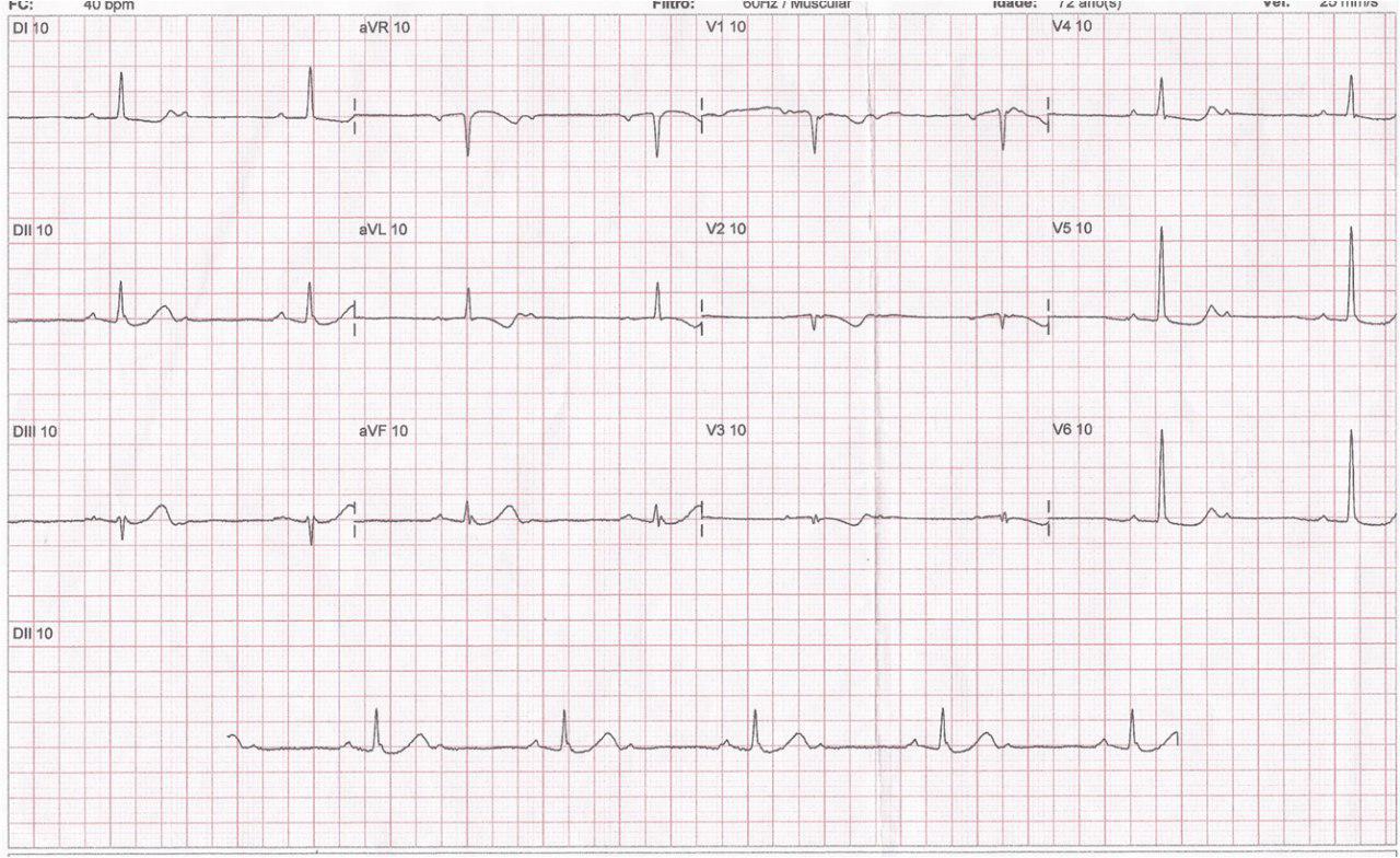Masculino de 63 años, diabético, con angor prolongado de 2 horas de evolución. Obstrucción proximal de CD