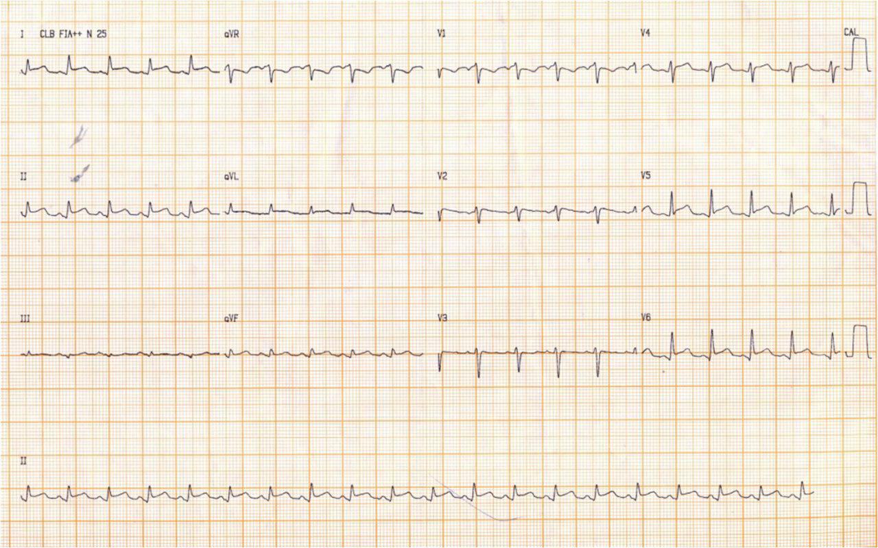 Hombre de 41 años, con antecedente «gripal», dolor pleuropericardítico y fiebre