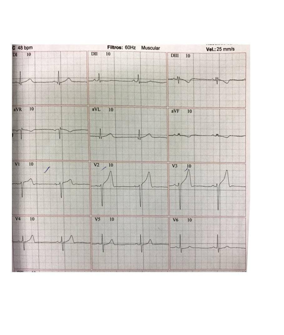 Masculino de 41 años, diabético, con episodio de angor prolongado. Obstrucción de DA total y angioplastia