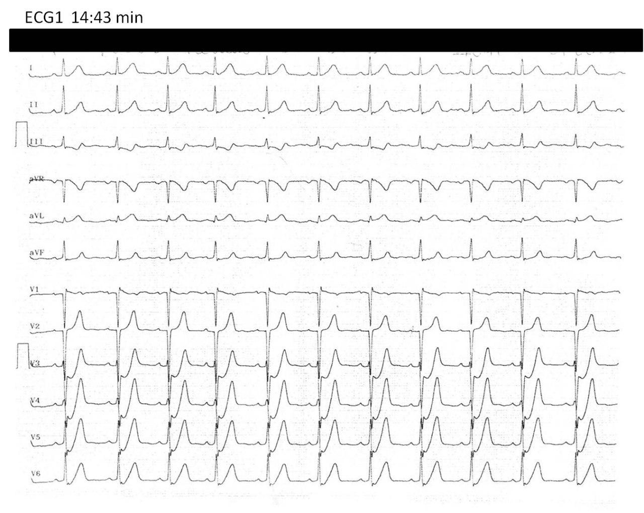 Paciente de 53 años, HTA y DBT, con angor prolongado. Obstrucción tercio medio de DA que se angioplastia. Circulación colateral desde CD