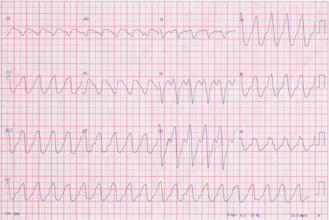 Masculino de 31 años con miocardiopatía dilatada no isquémica con CDI implantado. TV epicárdica incesante