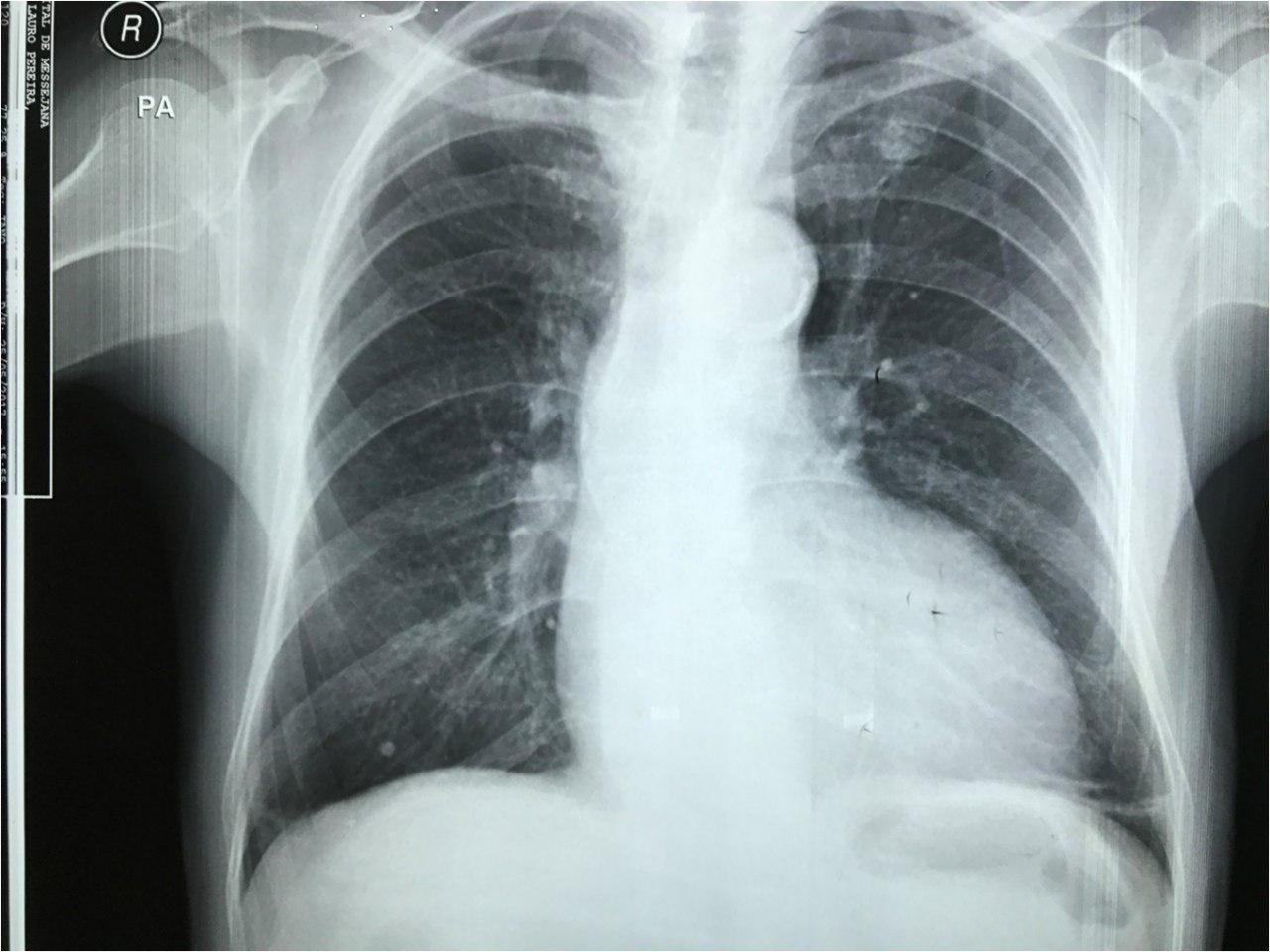 Paciente con angor y disnea progresiva por estenosis aórtica severa, calcificada