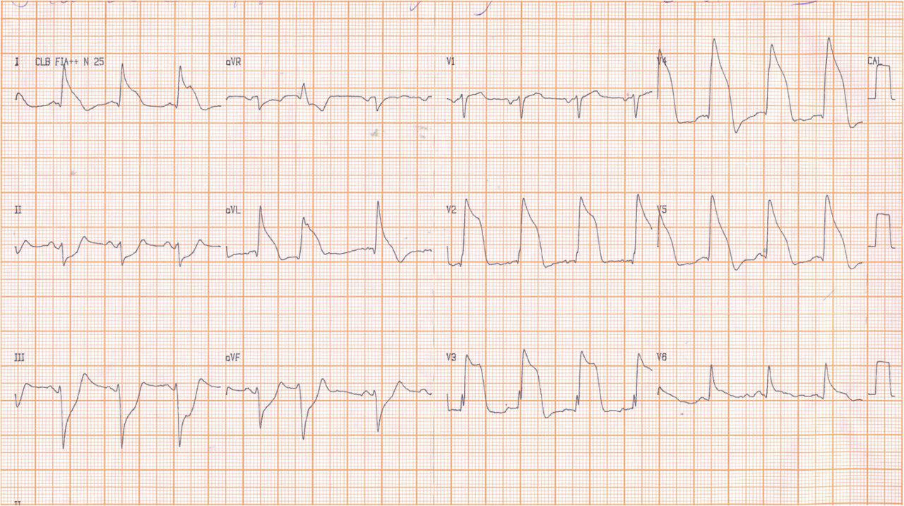 Masculino de 71 años con angor prolongado de aparición brusca