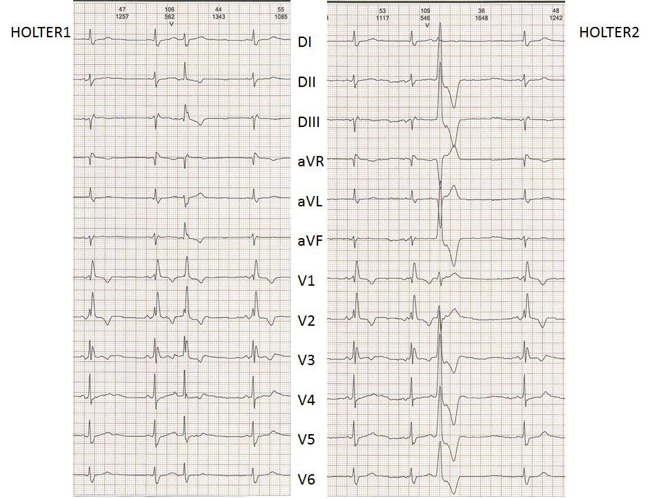 Mujer de 61 años con ectopias auriculares bloqueadas simulando BAV