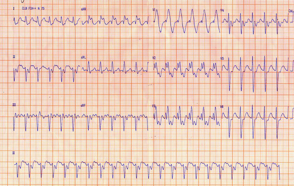 Aleteo 2:1 con BCRD depués de la reparación de una Tetralogía de Fallot en adulto