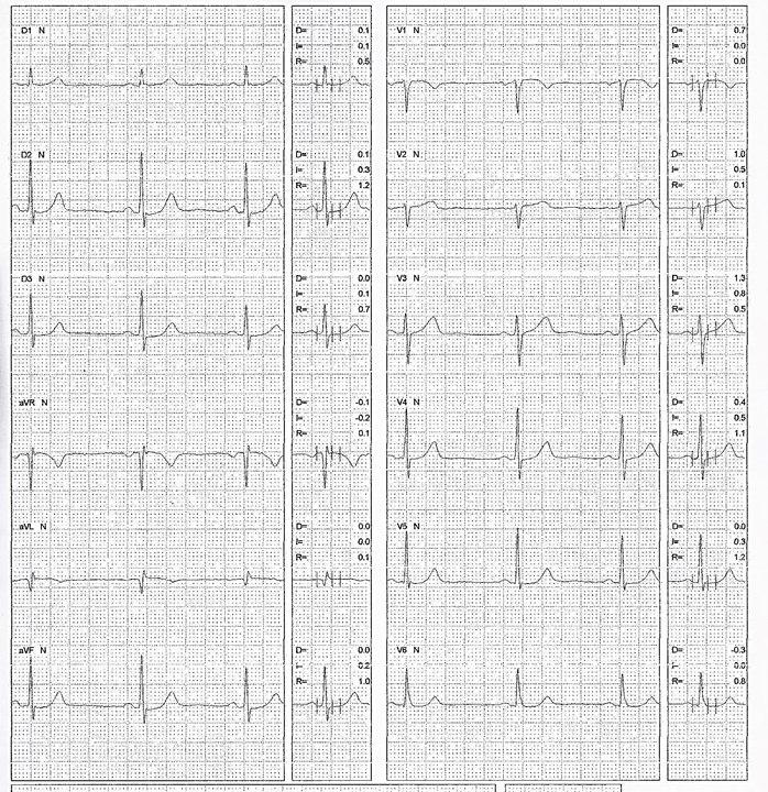 Masculino con factores de riesgo con ergometría positiva por lesión de TCI y lesiones  multivasos