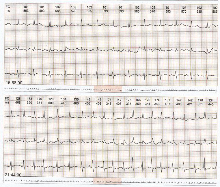 Femenina de 86 años con infección respiratoria y FA tratada con múltiples drogas