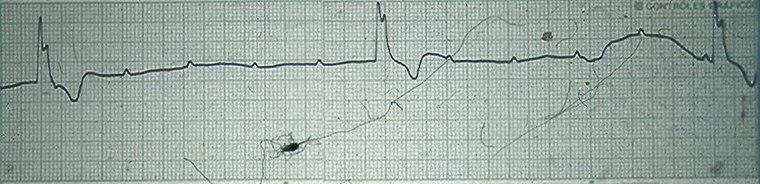 Falla de generador de marcapasos por defecto de detección debido a oversensing