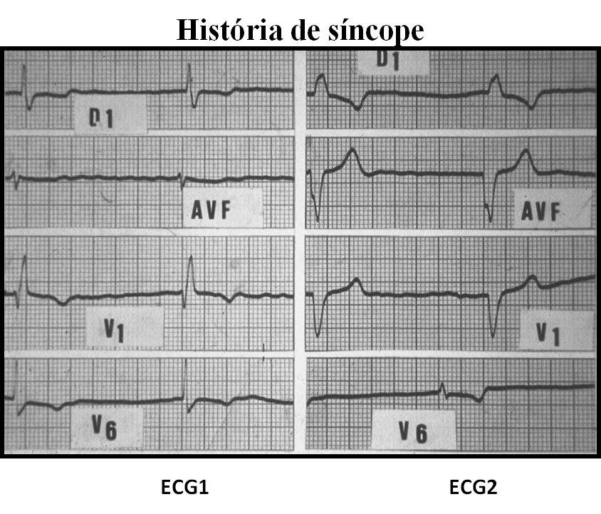 Paciente de 77 años con FA y Bloqueo de rama alternante. Posible enfermedad de Lev