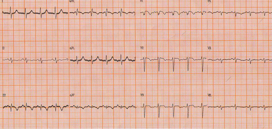 Femenina de 27 años con cuadro de dolor y disnea post consumo de cocaína. Presenta grave cuadro de TEP con óbito