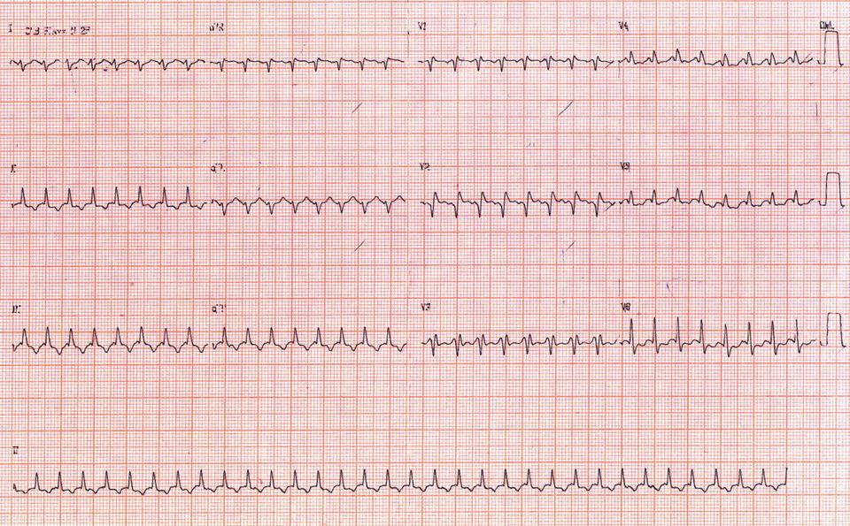 Arritmia en portador de anomalía de Ebstein en uso de digital y respuesta a la amiodarona