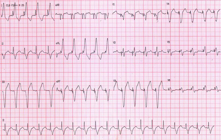 Palpitaciones en portadora de marcapasos y comportamiento ante un imán