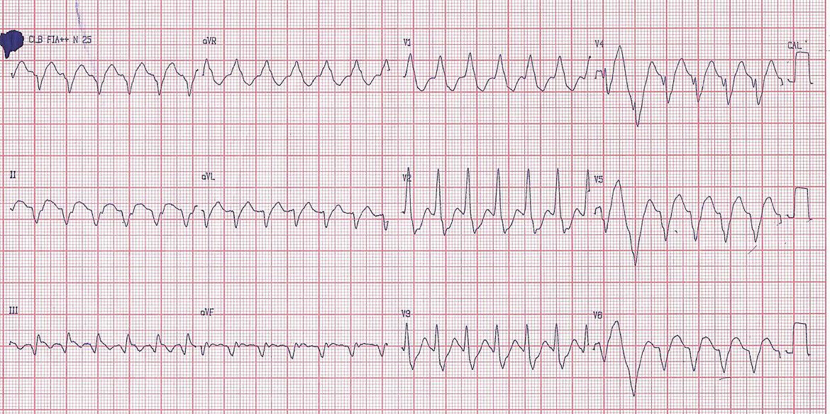 Masculino con SCACEST que tras angioplastia de Cx presenta taquicardia de QRS ancho