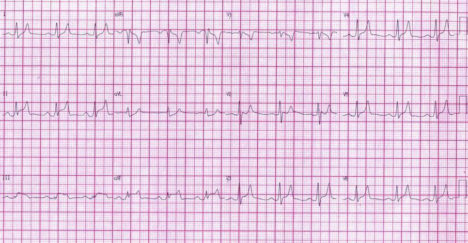 Paciente de 71 años con severa hiperpotasemia de 8,5 mEq/l simulando en ECG un SCA y luego de la corrección