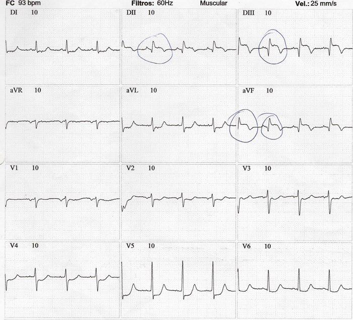 Masculino de 64 años con angor prolongado y disnea. Presenta soplo sistólico