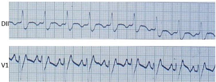 Taquicardia auricular 2 a 1 en paciente con reemplazo valvular mitral