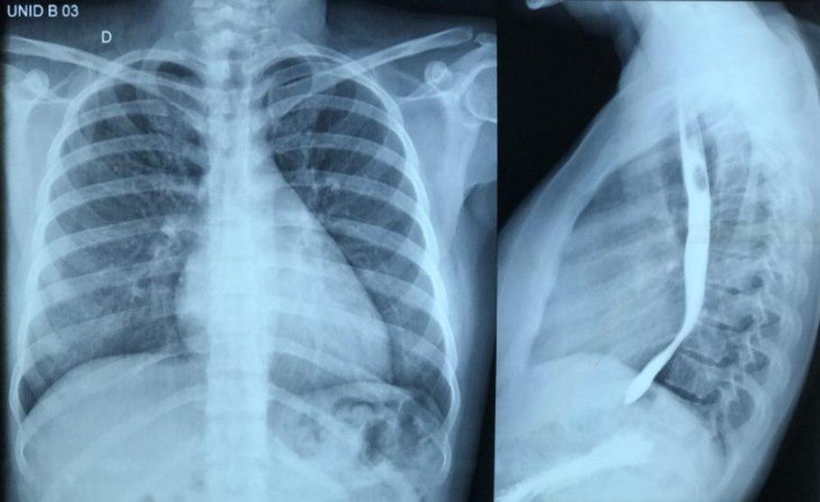 Mujer de 27 años cursando embarazo de 26 semanas, con  disnea y hemoptisis por enfermedad mitral