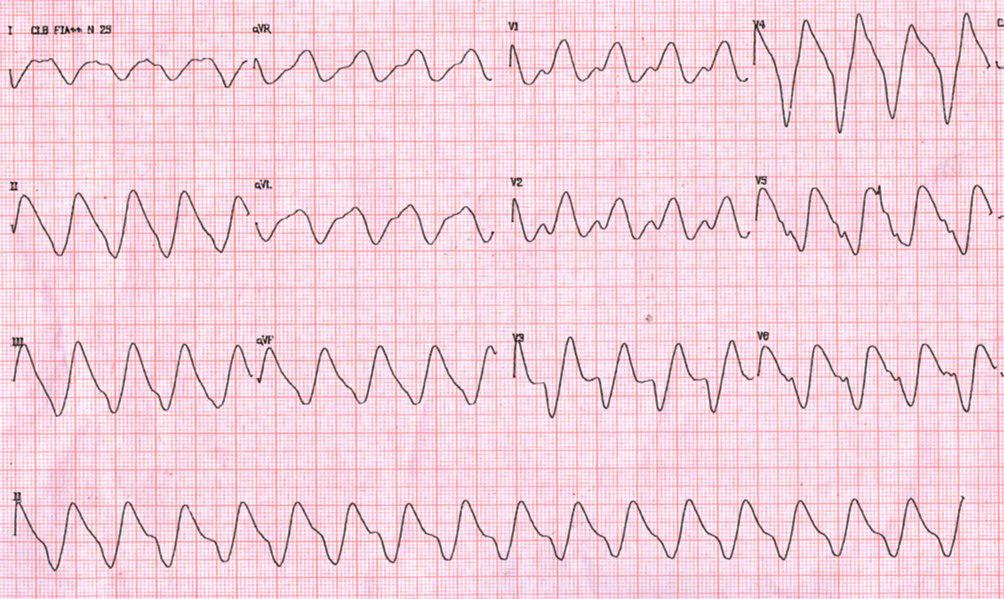 Taquicardia de QRS ancho con trastorno inespecífico de conducción por hiperpotasemia
