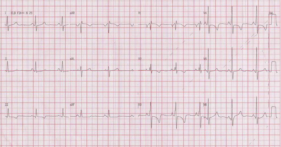 Femenina de 22 años con disnea progresiva por estenosis mitral reumática