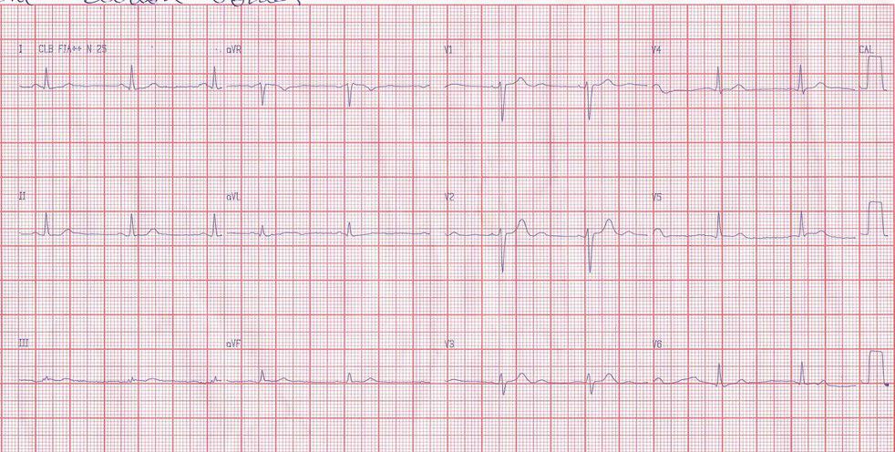 Paciente de 51 años con angor prolongado por lesión de la arteria marginal de la Cx