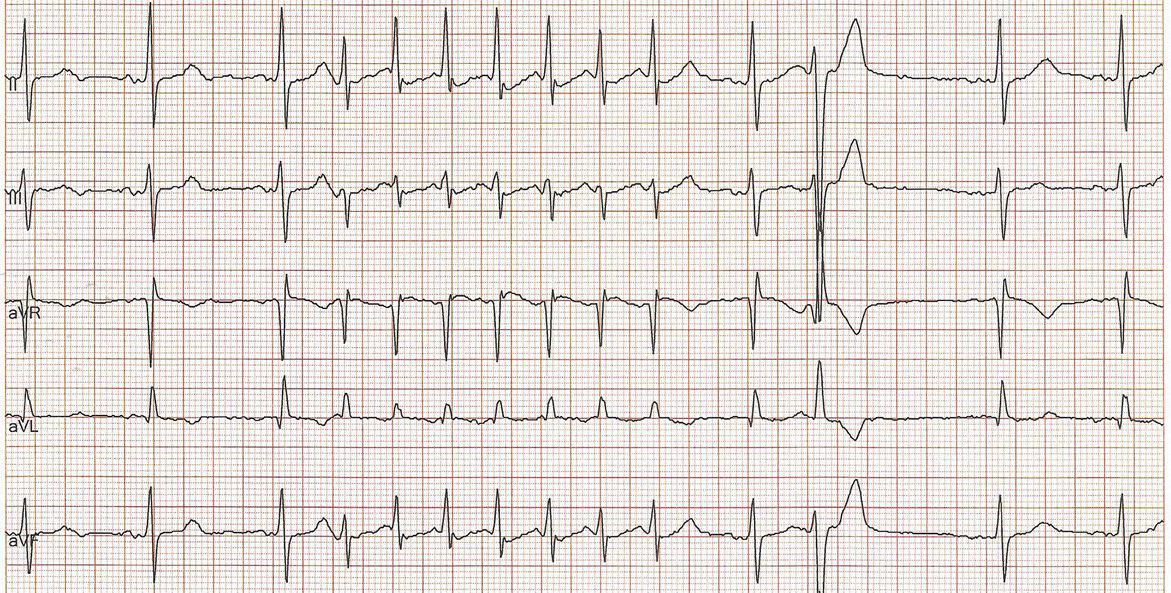 Paciente de 78 años con ACV precio, portador de BIA-A y FA paroxística constituyendo un Síndrome de Bayés
