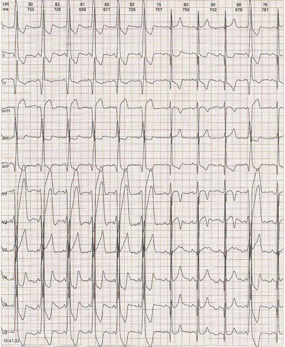 Paciente con diagnóstico previo de BRI que presenta WPW intermitente  asociado a memoria cardíaca