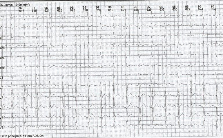 Paciente de 41 años en uso de amitriptilina