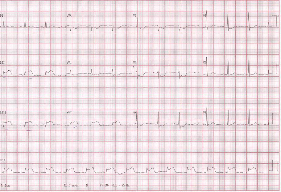 Paciente de 56 años con SCA por obstrución de arteria Cx