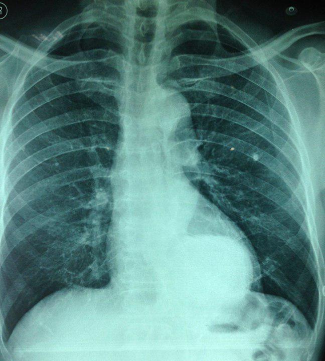 Paciente de 66 años, HTA y fumador con aneurisma tóracoabdominal. Reparación quirúrgica y endovascular