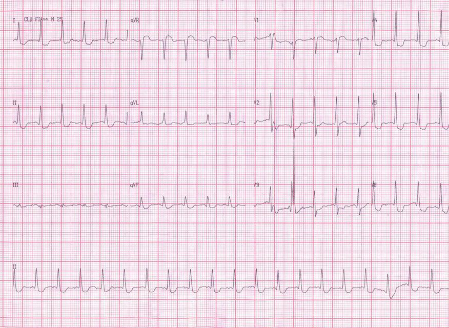 Anciano que presenta TA con BAV variable por intoxicación digitálica, tratado con sulfato de magnesio y difenilhidantoína