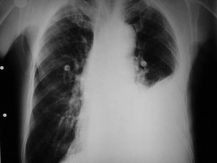 Masculino de 75 años, hipertenso con dolor toráccico por ruptura de aorta y hemotórax
