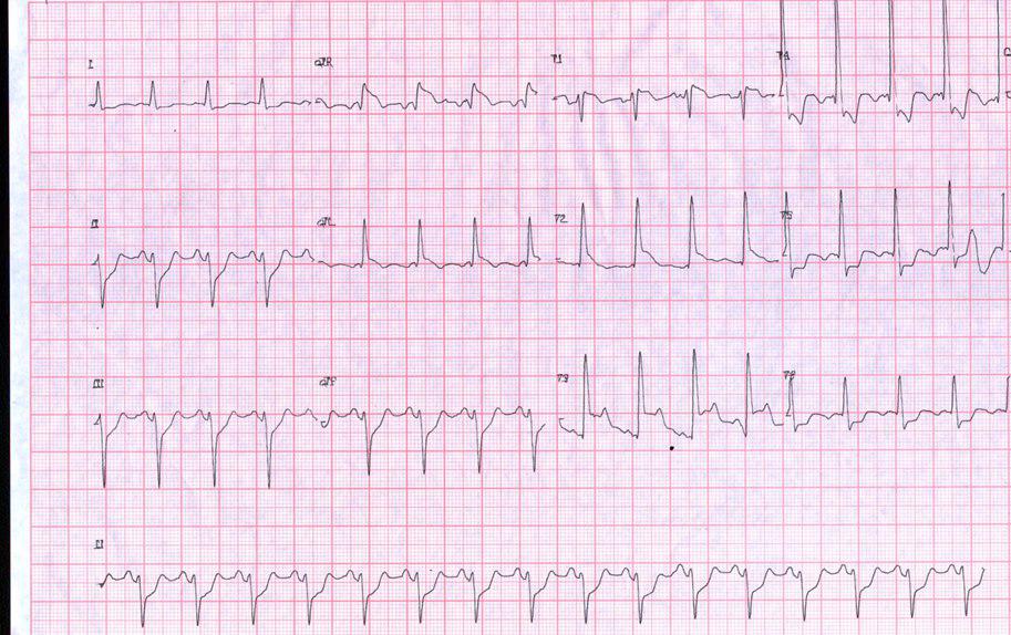 Paciente de 72 años con angor prolongado por lesión crítica de TCI y DA proximal